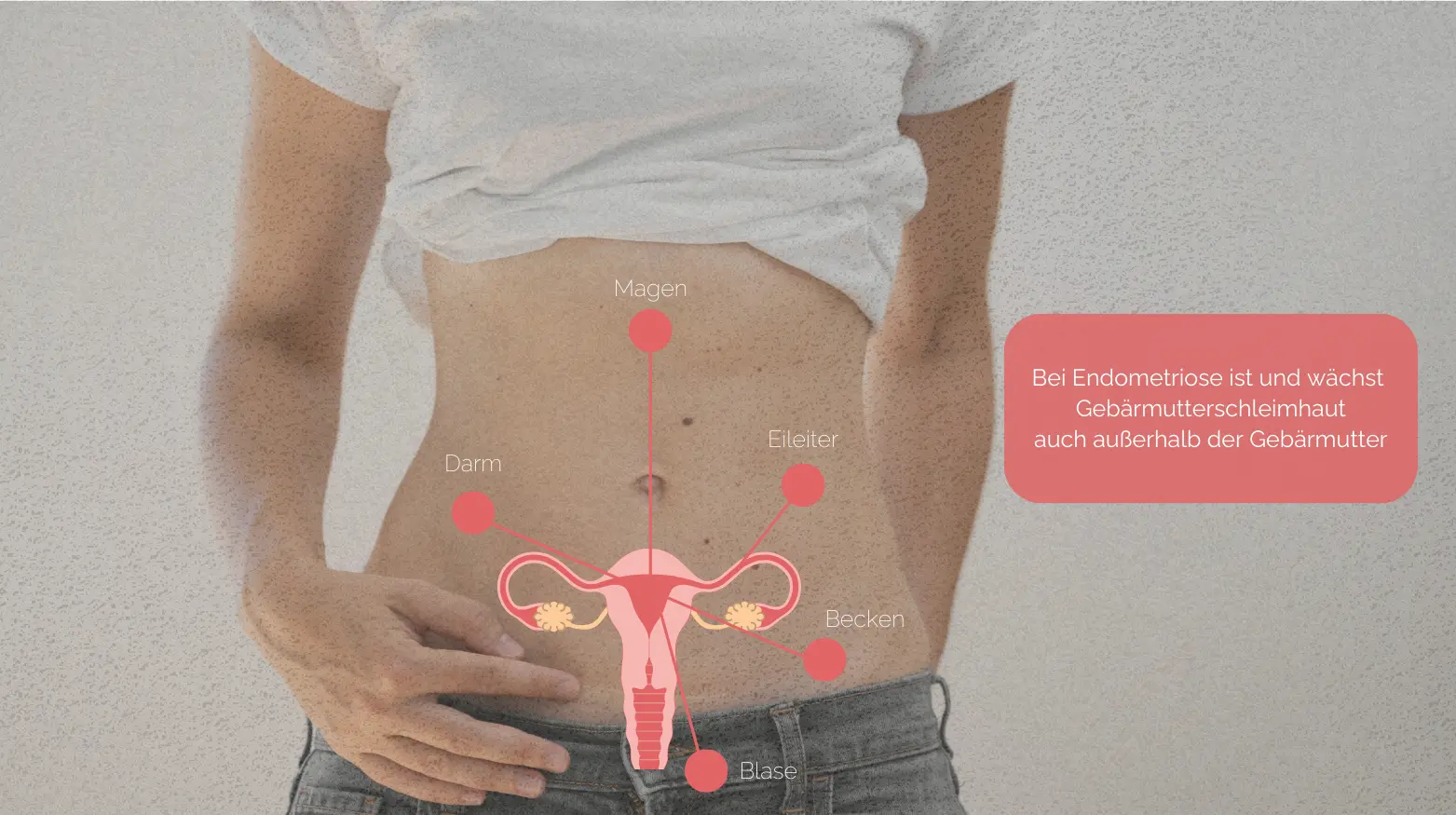 Schematische Darstellung der Endometriose an einem Torso mit Gebärmutter, Eileitern, Darm, Blase und Becken.