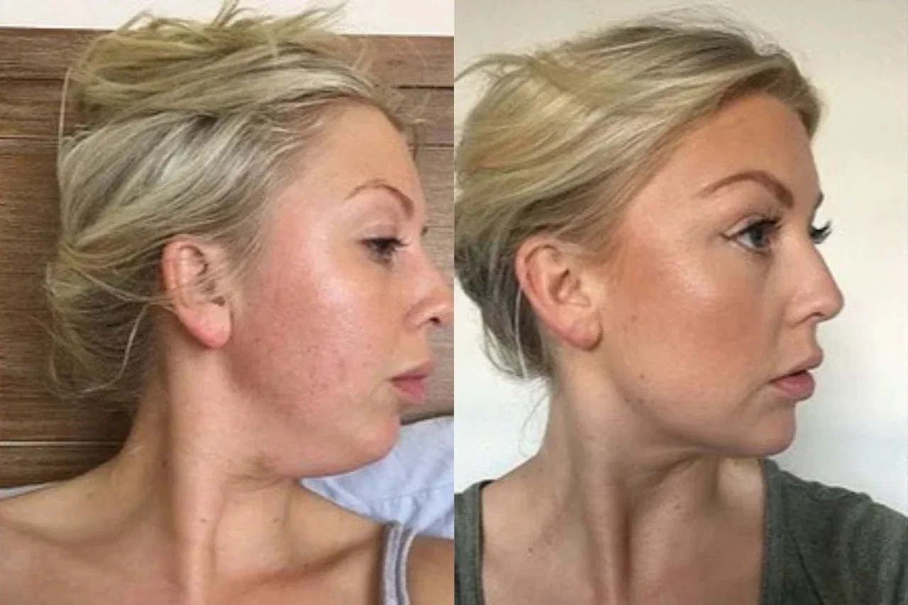Sara, 32 — före och efter