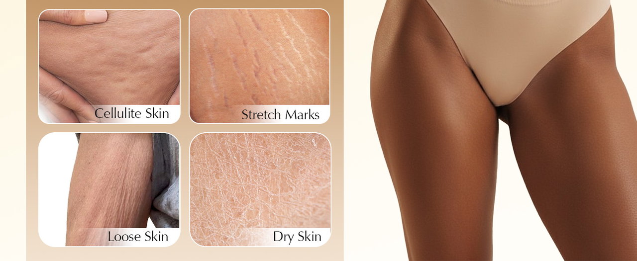 Cellulite, stretch marks, loose skin and dry skin concerns
