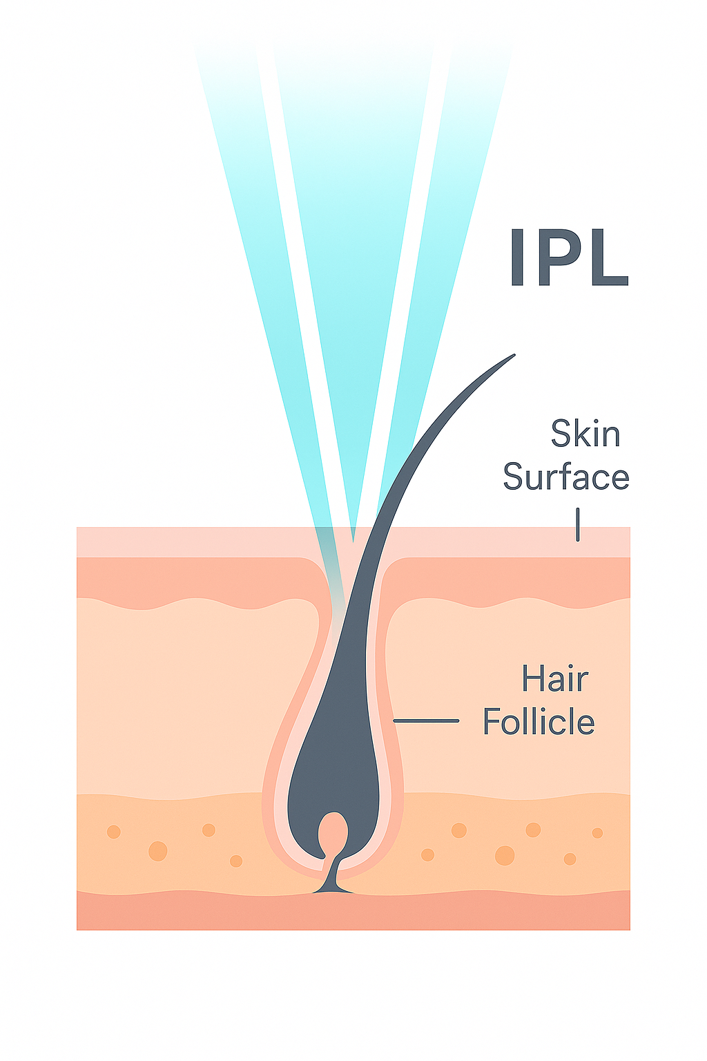Illustration showing IPL light targeting the hair follicle beneath the skin surface