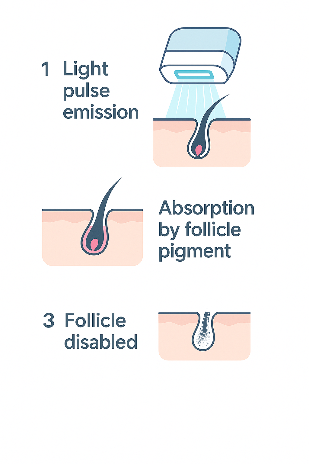 Diagram showing the stages of IPL: light emission, pigment absorption, and follicle disabled