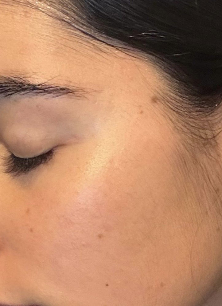 Après Seoni : éruptions cutanées sur le visage