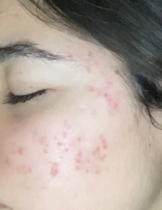 Avant Seoni : éruptions cutanées sur le visage