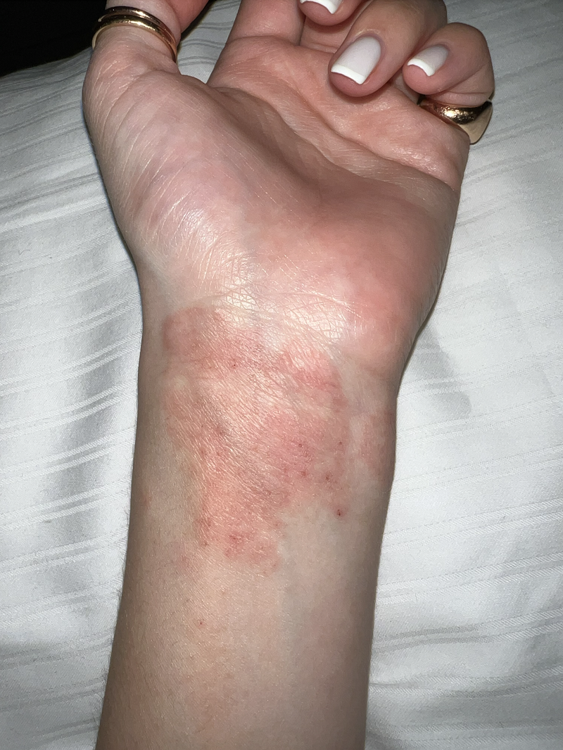 Avant Seoni : eczéma au poignet