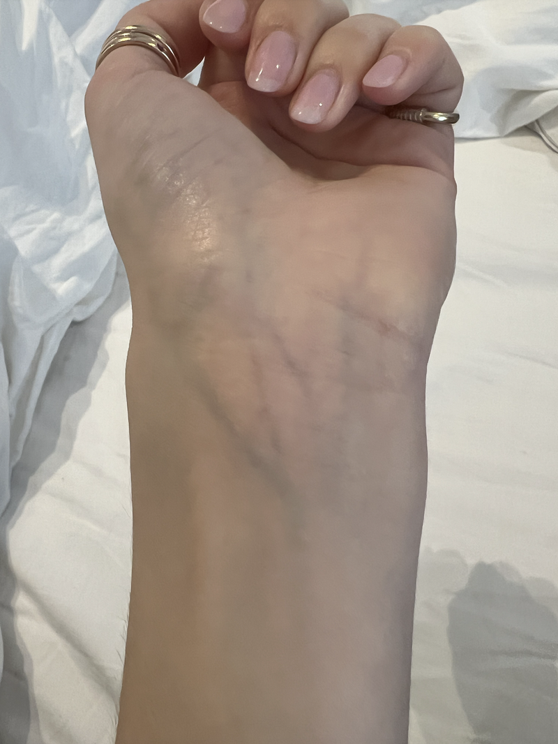 Après Seoni : eczéma au poignet