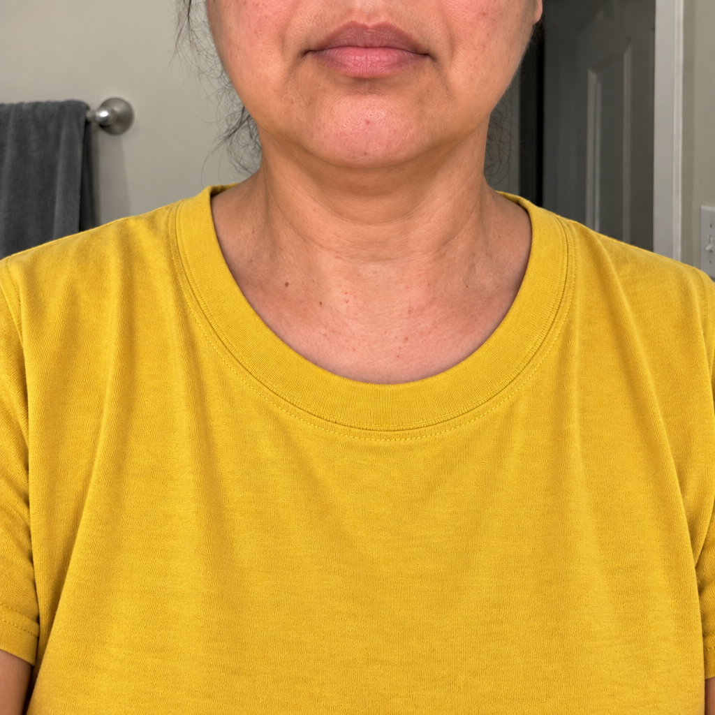 After 1 month: the same front view of her lower face, jawline and neck