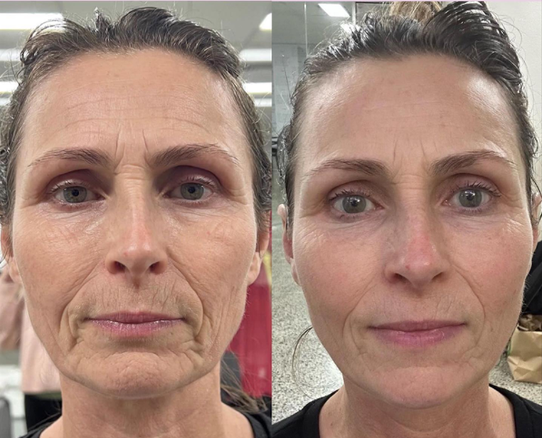 Before: front view of Sonya's face, with deeper lines around the mouth, cheeks and forehead