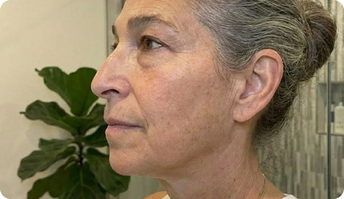 Résultat après 2 minutes — visage moins gonflé